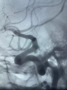 Treating Multiple ICA Aneurysms